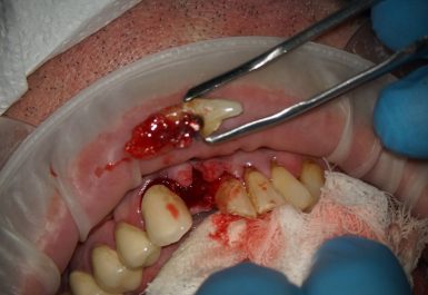 удаление зуба батуми