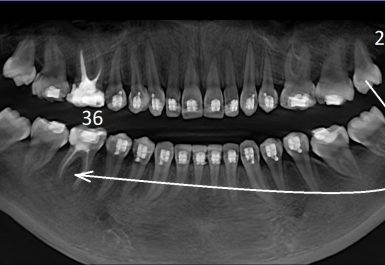 пересадка родных зубов