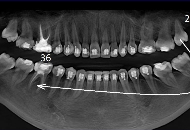 Пересадка родных зубов в Батуми. Трансплантация зубов My Dent