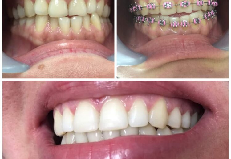 Orthodontics: The Art of Perfect Smile